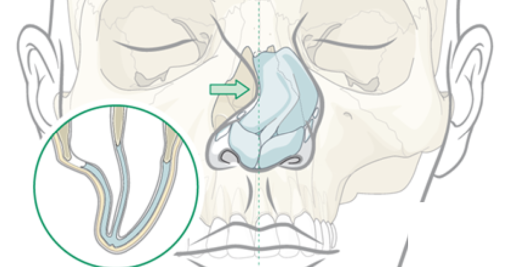 fractured nose symptoms