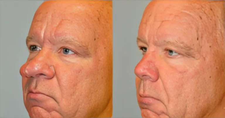 What is Rhinophyma about the nose?